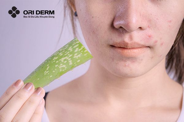 Cách trị mụn tại nhà bằng lá nha đam tươi