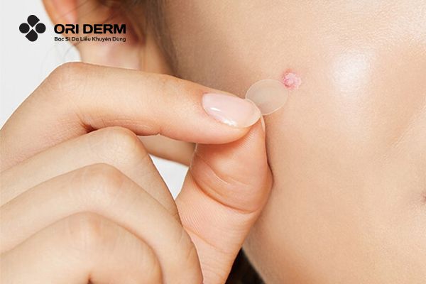 Dùng miếng dán mụn