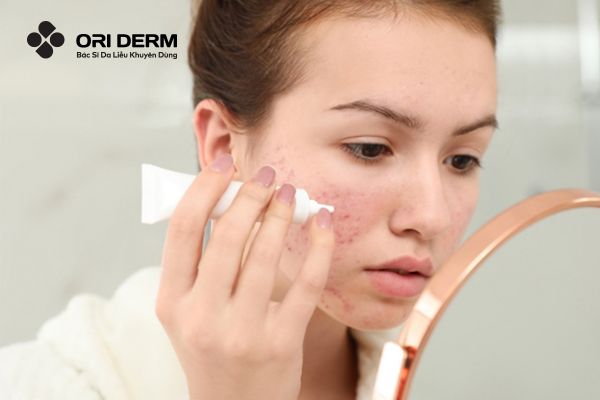 Cách giảm mụn viêm đỏ bằng sản phẩm không kê đơn