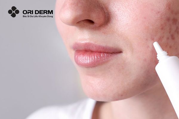 Cách trị mụn thâm tụ máu bằng thuốc bôi