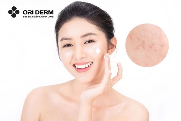 Top 8 Thuốc Trị Sẹo Thâm Tốt Được Sử Dụng Nhiều Hiện Nay