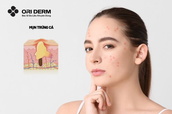 Mọi Thứ Bạn Cần Biết Về Mụn Trứng Cá Để Đánh Bay Chúng Hiệu Quả Hơn