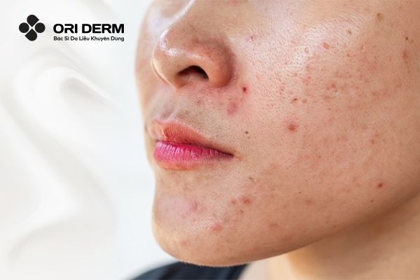 Đặc điểm của làn da trong giai đoạn dậy thì