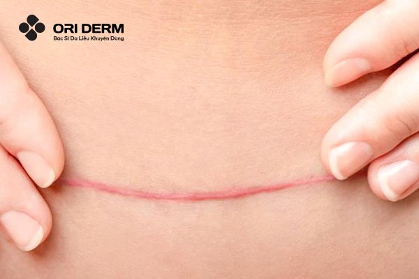 Nguyên nhân hình thành sẹo sau phẫu thuật