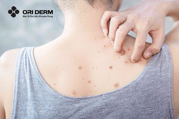 Top 7 Xà Phòng Trị Mụn Lưng Hiệu Quả Bạn Nên Thử