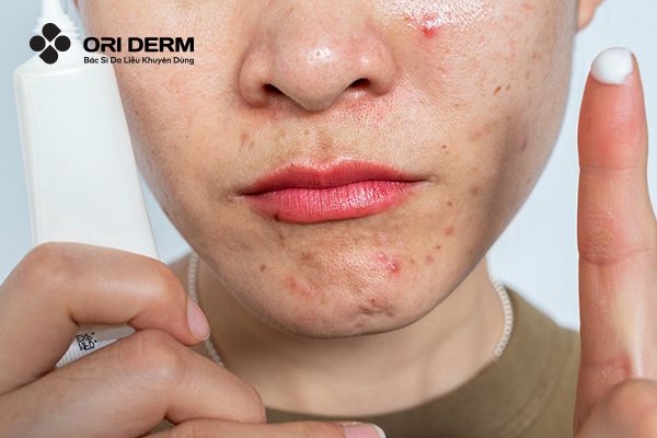 Dùng Retinol Bị Lên Mụn: Nguyên Nhân Và Cách Khắc Phục Tốt