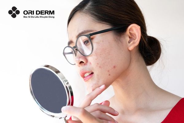 Mụn nội tiết là gì? Nguyên nhân và dấu hiệu nhận biết