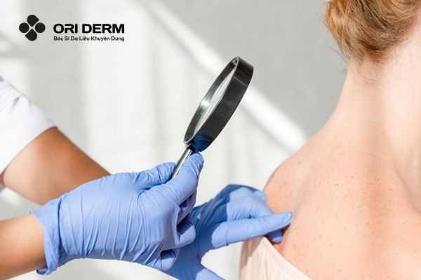 Các nguyên tắc cần biết khi điều trị mụn lưng