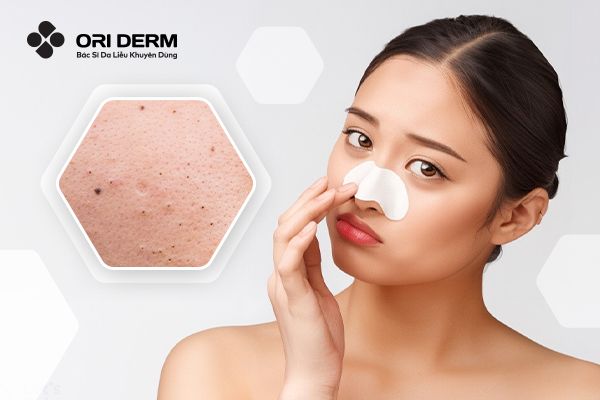 Top 10 Sản Phẩm Kem Trị Mụn Đầu Đen Và Ngừa Thâm Hiệu Quả Nhất