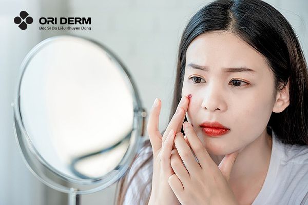 Mụn Viêm Đỏ Không Nhân Là Gì? Cách Điều Trị & Lưu Ý Cần Nắm
