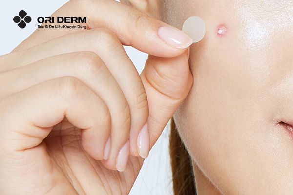 Gom cồi mụn là gì?