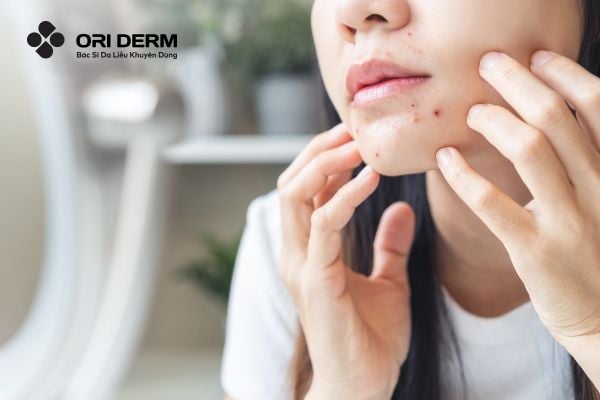 Tác dụng phụ của thuốc bôi gom cồi mụn và cách khắc phục