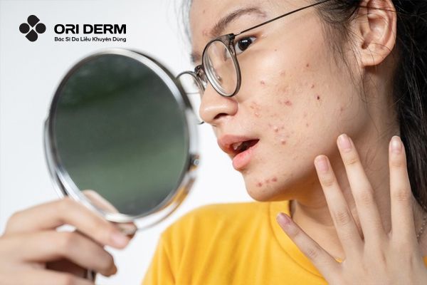 Nguyên nhân chính gây mụn viêm