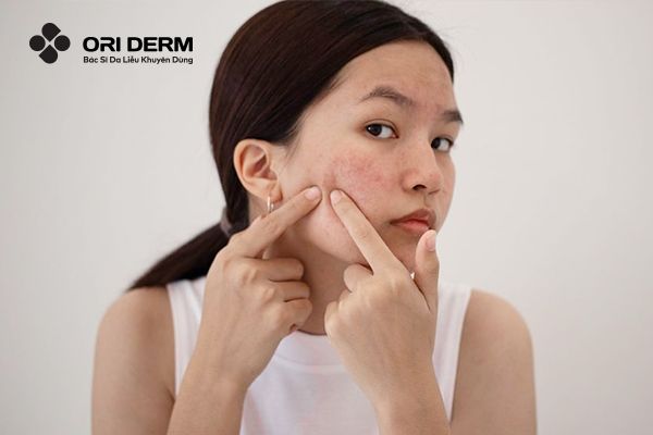 Nguyên nhân hình thành sẹo rỗ phổ biến