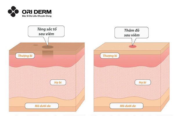 Nguyên nhân hình thành thâm đỏ sau mụn