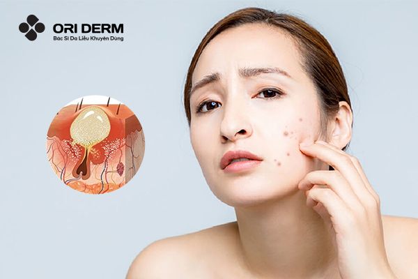 Mụn Viêm Có Tự Hết Không? Các Phương Pháp Điều Trị Mụn Viêm Hiệu Quả