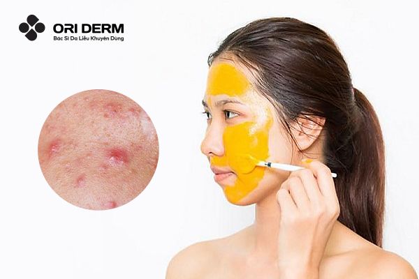 20 Cách Trị Mụn Viêm Đỏ Tại Nhà Giúp Giảm Sưng Hiệu Quả