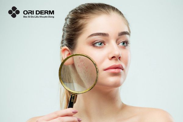 Sẹo Thâm Là Gì? Cách Trị Sẹo Thâm Hiệu Quả Không Nên Bỏ Qua