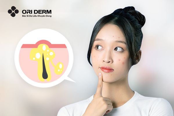 Các Loại Mụn Thường Gặp Và Cách Phân Biệt Để Điều Trị