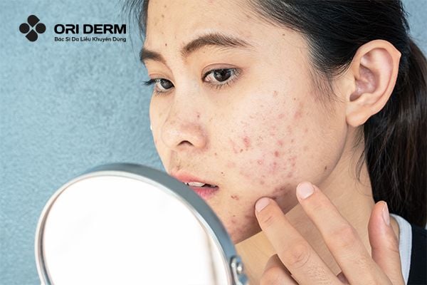 Nguyên nhân hình thành mụn ở quai hàm