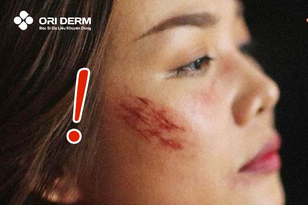 Những lưu ý khi trị thâm mụn bằng nghệ tại nhà