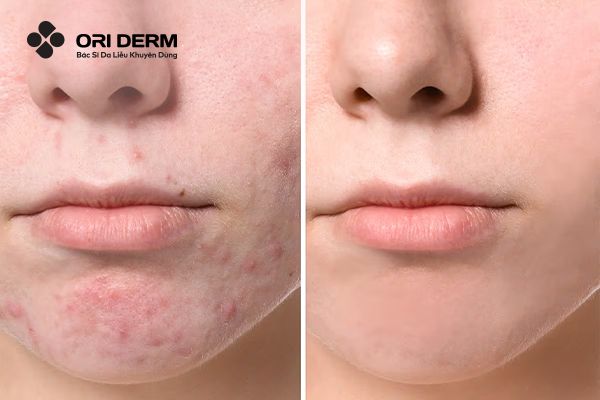 Lợi ích của peel retinol đối với làn da