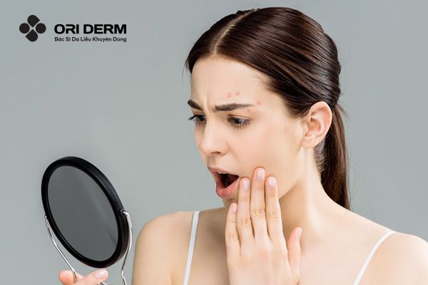 Nguyên Nhân Và Phương Pháp Điều Trị Mụn Mọc Ở Lông Mày