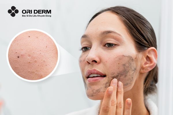 Bí Quyết Chăm Sóc Da Mụn Đầu Đen Tại Nhà Đơn Giản Nhưng Hiệu Quả