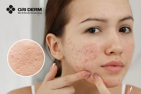 Sẹo Mụn Có Tự Hết Không? Khám Phá Các Giải Pháp Xóa Sẹo Mụn Hiệu Quả