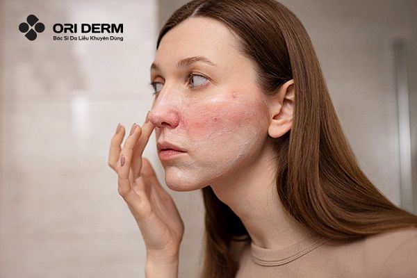 Sau Khi Peel Da Bị Đỏ Rát Có Nguy Hiểm Không? Cách Xử Lý Như Thế Nào?