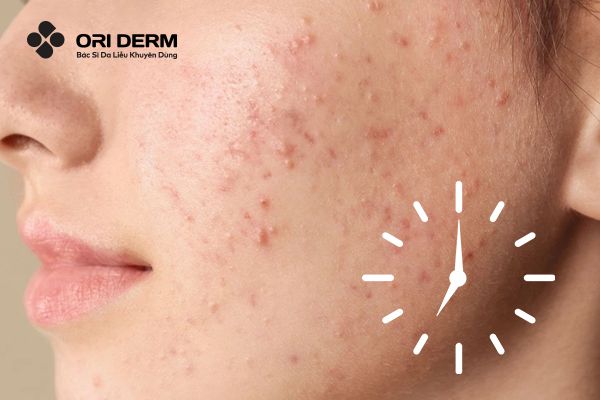 Quá trình đẩy mụn ẩn thường diễn ra bao lâu?