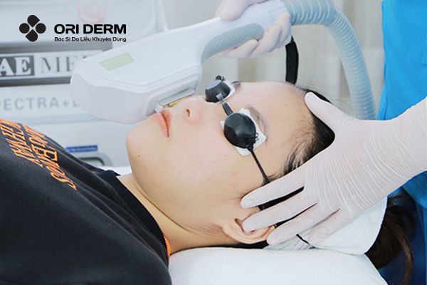 IPL (Intense Pulsed Light)