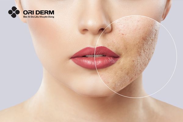 Vitamin E trị sẹo rỗ có hiệu quả không?