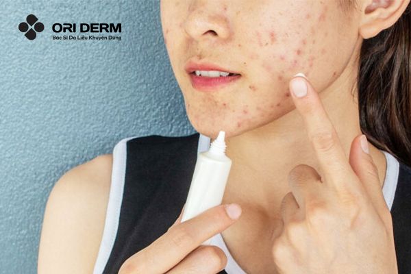 Kem trị mụn