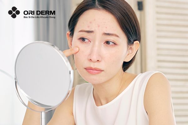 Cách Nhận Diện Mụn Ẩn Trên Trán Và Cách Khắc Phục