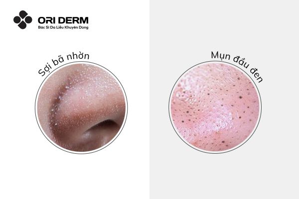 Tổng quan về mụn đầu đen và sợi bã nhờn