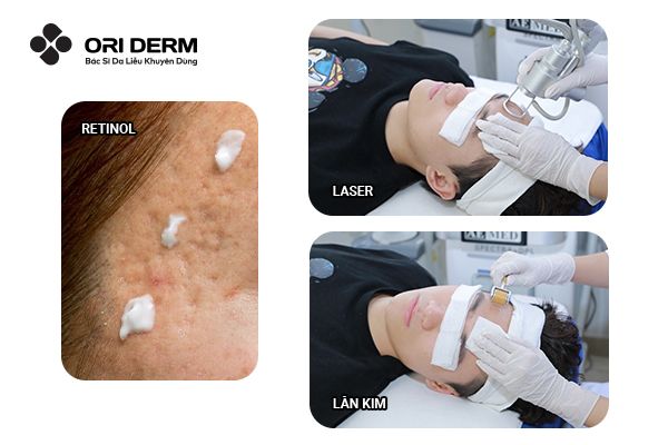So sánh hiệu quả giữa retinol và phương pháp điều trị sẹo rỗ khác