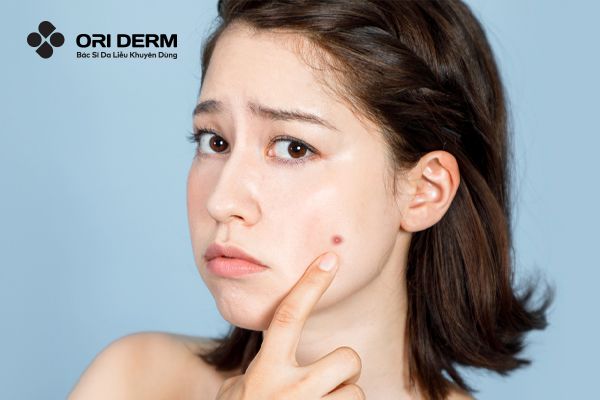 Nguyên Nhân Mụn Tái Đi Tái Lại Và Cách Điều Trị Hiệu Quả