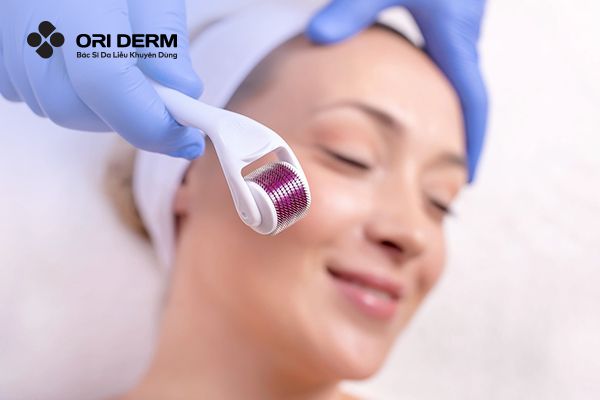 Lăn kim làm mờ sẹo rỗ là gì?