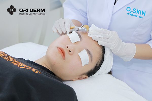 Lăn kim trị mụn