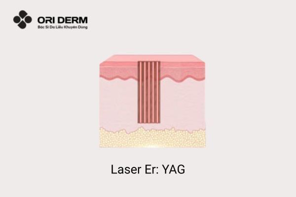 Laser Er: YAG