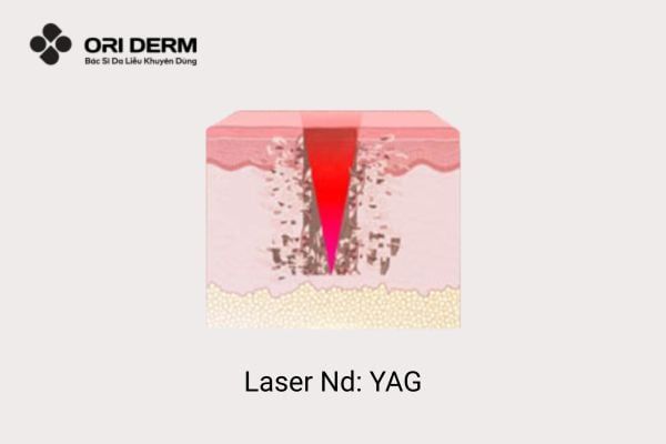 Laser Nd: YAG