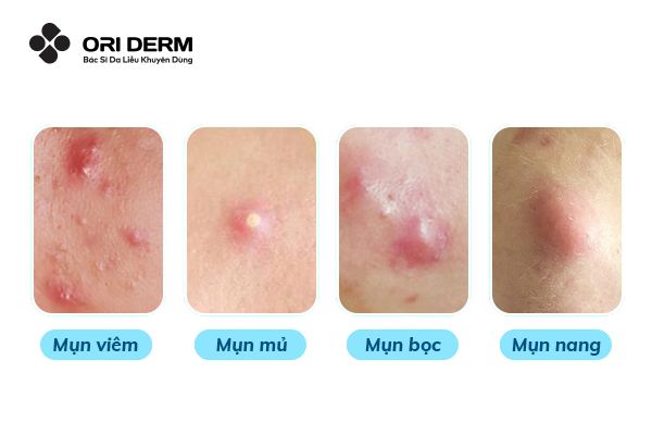 Mụn viêm là gì? Mụn viêm có mấy loại phổ biến?