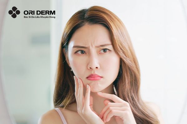 Những Sai Lầm Phổ Biến Khi Chăm Sóc Da Mụn Mà Bạn Cần Tránh