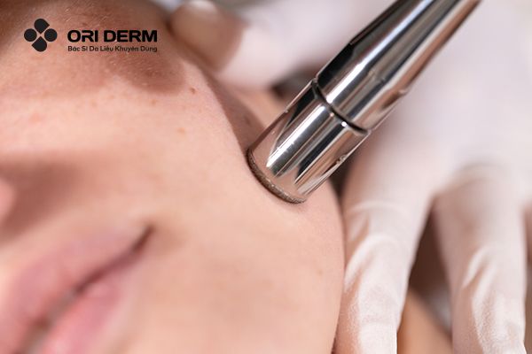 Mài da vi điểm trị sẹo rỗ