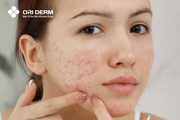 Vậy mặt mụn có nên đắp mặt nạ giấy không?