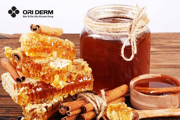 Trị mụn viêm đỏ tại nhà bằng mặt nạ quế và mật ong