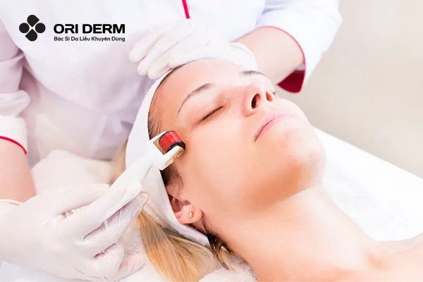 Micro-Needling trị sẹo mụn