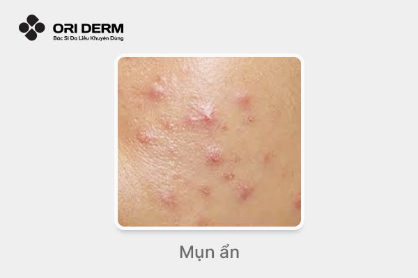 Hình ảnh mụn ẩn