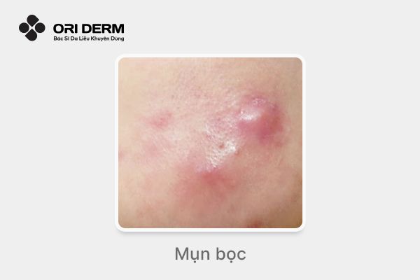 Hình ảnh mụn bọc